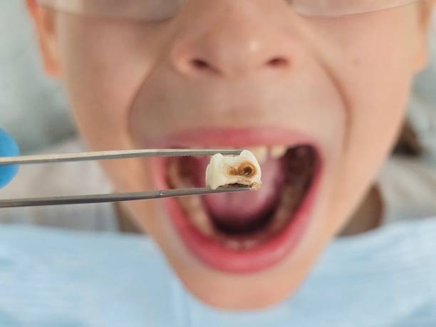Best Emergency Root Canal Treatment in Harrisonville, MO